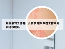 银屑病对工作有什么要求 银屑病在工作中受到过歧视吗