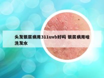 头发银屑病用311uvb好吗 银屑病用啥洗发水