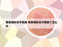 银屑病肘关节抓破 银屑病肘关节抓破了怎么办