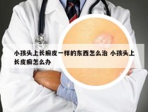 小孩头上长癣皮一样的东西怎么治 小孩头上长皮癣怎么办