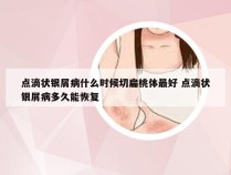 点滴状银屑病什么时候切扁桃体最好 点滴状银屑病多久能恢复