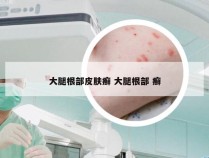 大腿根部皮肤癣 大腿根部 癣