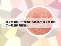 脖子后面长了一片癣的东西图片 脖子后面长了一片癣的东西图片