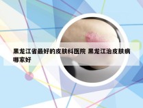 黑龙江省最好的皮肤科医院 黑龙江治皮肤病哪家好