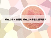 眼皮上会长癣图片 眼皮上长癣怎么回事图片