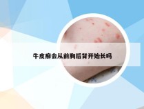 牛皮癣会从前胸后背开始长吗