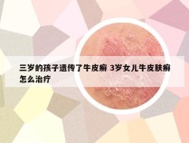 三岁的孩子遗传了牛皮癣 3岁女儿牛皮肤癣怎么治疗