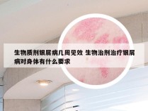 生物质剂银屑病几周见效 生物治剂治疗银屑病对身体有什么要求