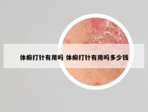 体癣打针有用吗 体癣打针有用吗多少钱