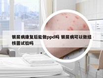 银屑病康复后能做ppd吗 银屑病可以做结核菌试验吗