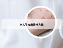 小儿牛皮癣治疗方法