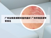 广州治银屑病哪家医院最好 广州市银屑病专家排名