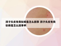 孩子头皮有类似癣是怎么回事 孩子头皮有类似癣是怎么回事啊