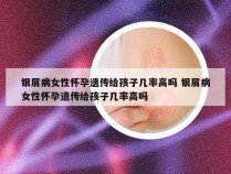 银屑病女性怀孕遗传给孩子几率高吗 银屑病女性怀孕遗传给孩子几率高吗