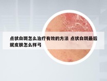 点状白斑怎么治疗有效的方法 点状白斑最后就皮肤怎么样弓