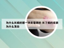 为什么长癣的那一块皮是硬的 长了癣的皮肤为什么发白