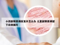 小孩副银屑病反复长怎么办 儿童副银屑病留下白斑图片