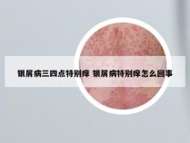 银屑病三四点特别痒 银屑病特别痒怎么回事