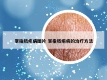 掌指脓疱病图片 掌指脓疱病的治疗方法