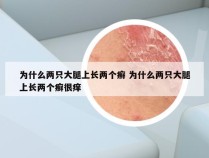 为什么两只大腿上长两个癣 为什么两只大腿上长两个癣很痒