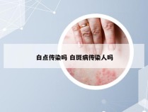 白点传染吗 白斑病传染人吗