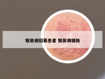 银屑病招募患者 银屑病援助