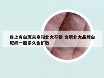 身上有白斑来阜阳北大不错 合肥北大品牌白斑病一般多久会扩散