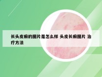 长头皮癣的图片是怎么样 头皮长癣图片 治疗方法