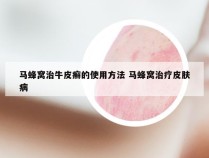 马蜂窝治牛皮癣的使用方法 马蜂窝治疗皮肤病