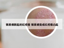 银屑病新起的红疙瘩 银屑病变成红疙瘩凸起