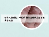 新生儿胳膊起了一片癣 新生儿胳膊上起了很多小疙瘩