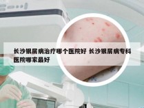 长沙银屑病治疗哪个医院好 长沙银屑病专科医院哪家最好