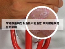 掌跖脓疱病怎么治能不能治愈 掌跖脓疱病是什么病啊