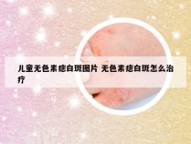 儿童无色素痣白斑图片 无色素痣白斑怎么治疗