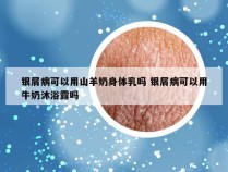 银屑病可以用山羊奶身体乳吗 银屑病可以用牛奶沐浴露吗