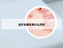 治疗白癜风用什么药好