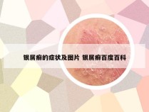 银屑癣的症状及图片 银屑癣百度百科