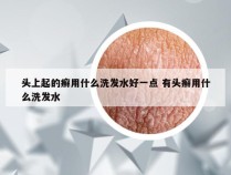 头上起的癣用什么洗发水好一点 有头癣用什么洗发水