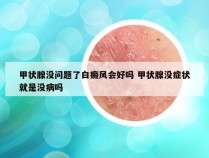 甲状腺没问题了白癜风会好吗 甲状腺没症状就是没病吗