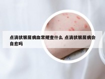 点滴状银屑病血常规查什么 点滴状银屑病会自愈吗