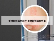 生物制剂治疗治疗 生物制剂治疗效果