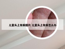 儿童头上有癣图片 儿童头上有癣怎么办