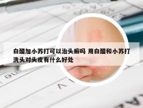 白醋加小苏打可以治头癣吗 用白醋和小苏打洗头对头皮有什么好处