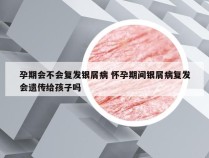 孕期会不会复发银屑病 怀孕期间银屑病复发会遗传给孩子吗