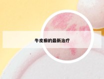 牛皮癣的最新治疗