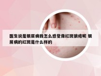 医生说是银屑病我怎么感觉像红斑狼疮呢 银屑病的红斑是什么样的