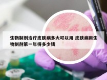 生物制剂治疗皮肤病多大可以用 皮肤病用生物制剂第一年得多少钱