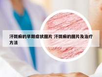 汗斑癣的早期症状图片 汗斑癣的图片及治疗方法