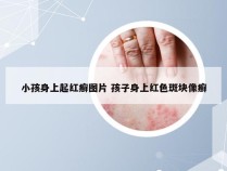 小孩身上起红癣图片 孩子身上红色斑块像癣