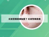 红皮型银屑病加重了 红皮性银屑病